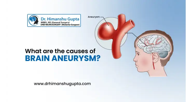 What Are The Causes Of Brain Aneurysms?